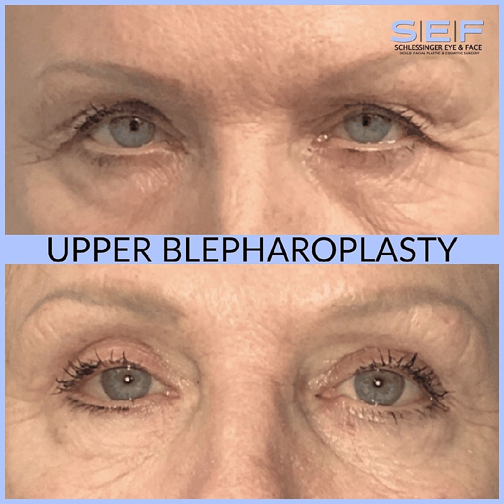Blepharoplasty: Let’s Break it Down