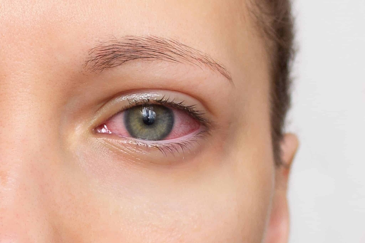 How is Dry Eye Treated?