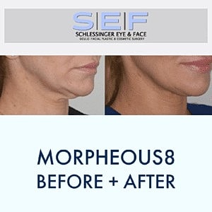 Target Deeper Layers of the Skin with Morpheus8 Microneedling