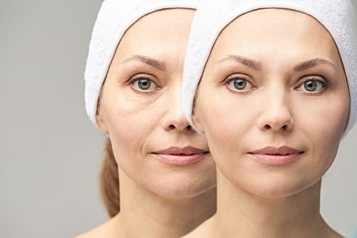 Under Eye Fillers: A Non-Surgical Option for Eye Bag Reduction