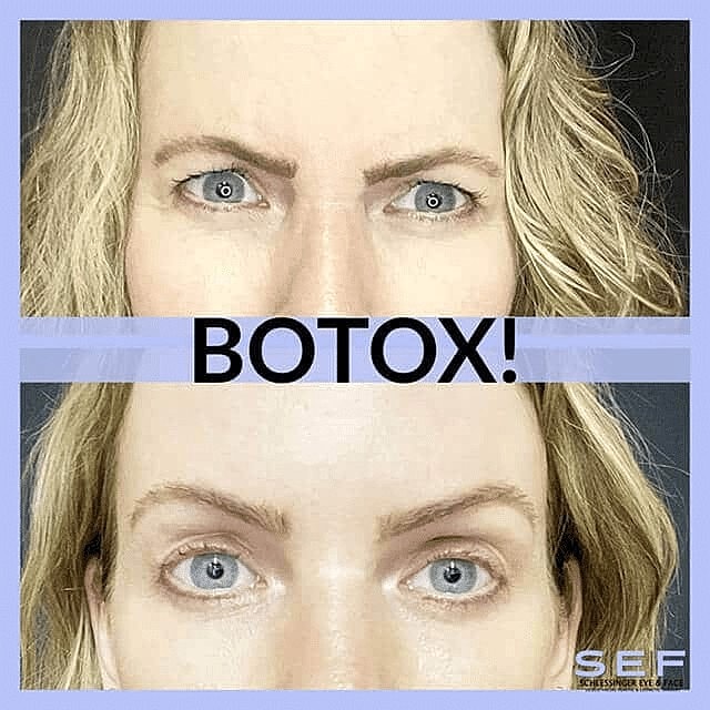 Who Is An Ideal Candidate for Botox?