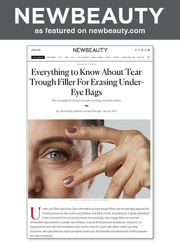 Tear trough filler article on under-eye bags