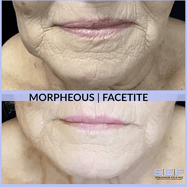 Facetite Before & After