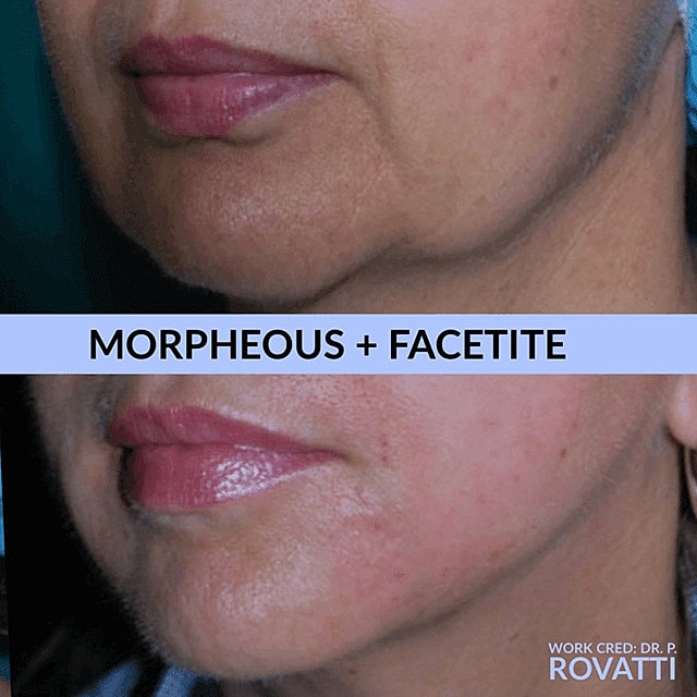 Facetite Before & After
