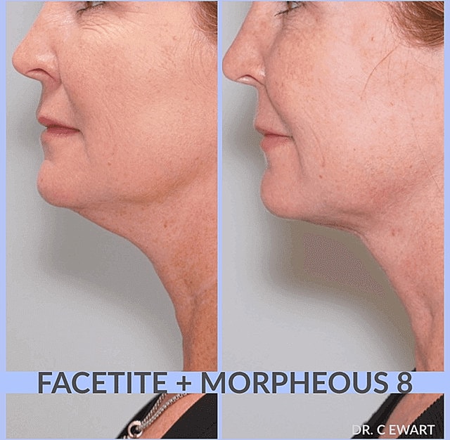Facetite Before & After