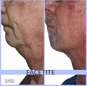Facetite Before & After