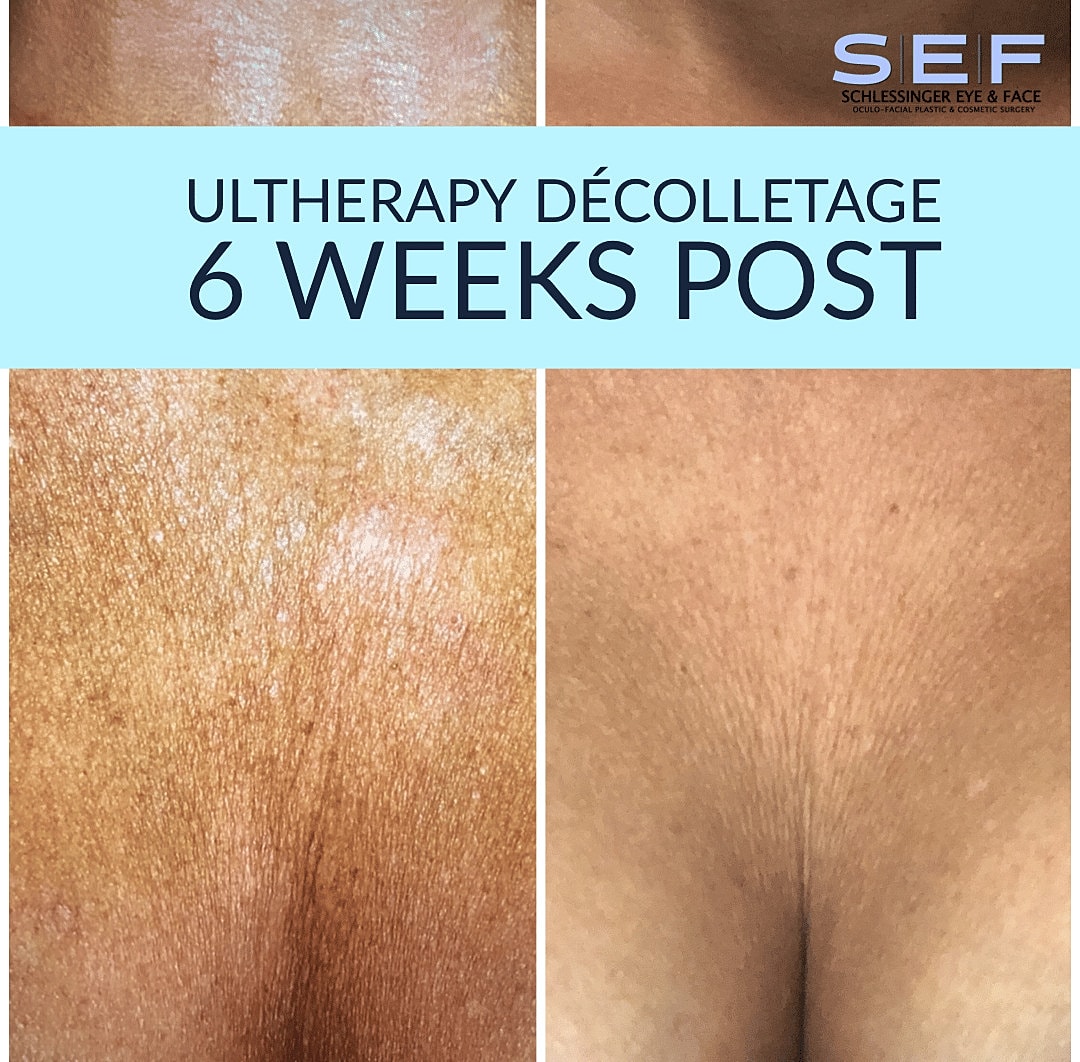 Ultherapy Before & After