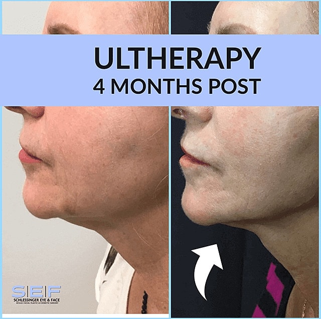 Ultherapy Before & After