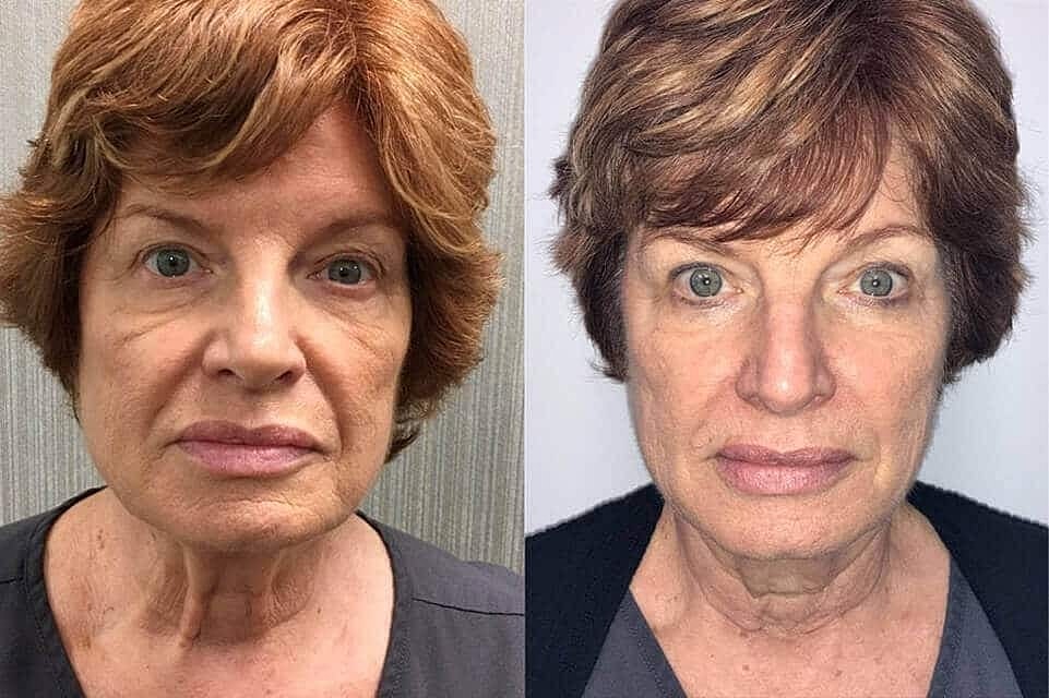 Ultherapy Before & After