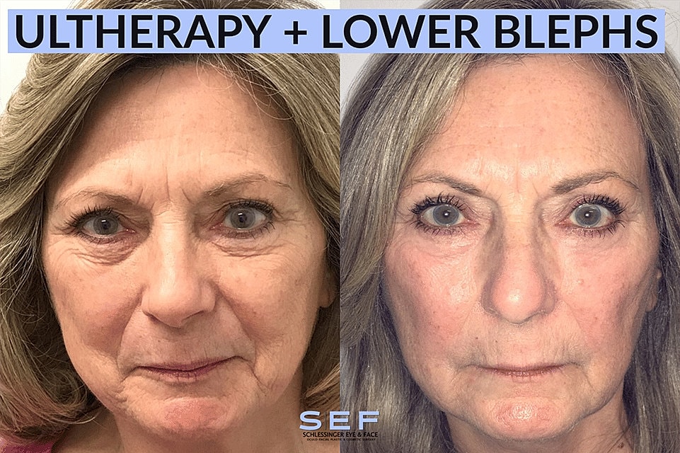 Ultherapy Before & After