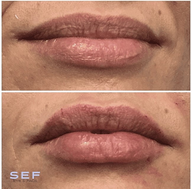 Restylane Before and After