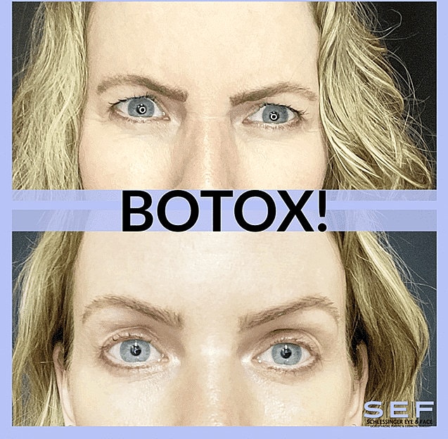 Botox Before & After