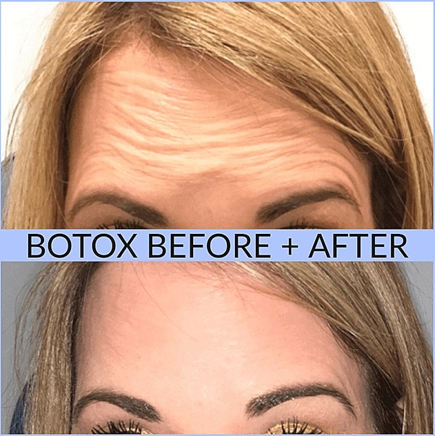 Botox Before & After