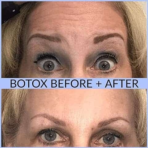 Botox Before & After