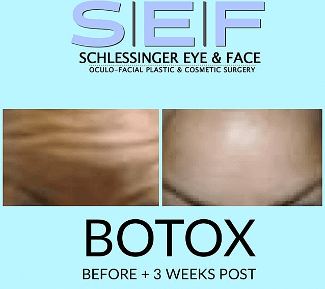 Botox Before & After