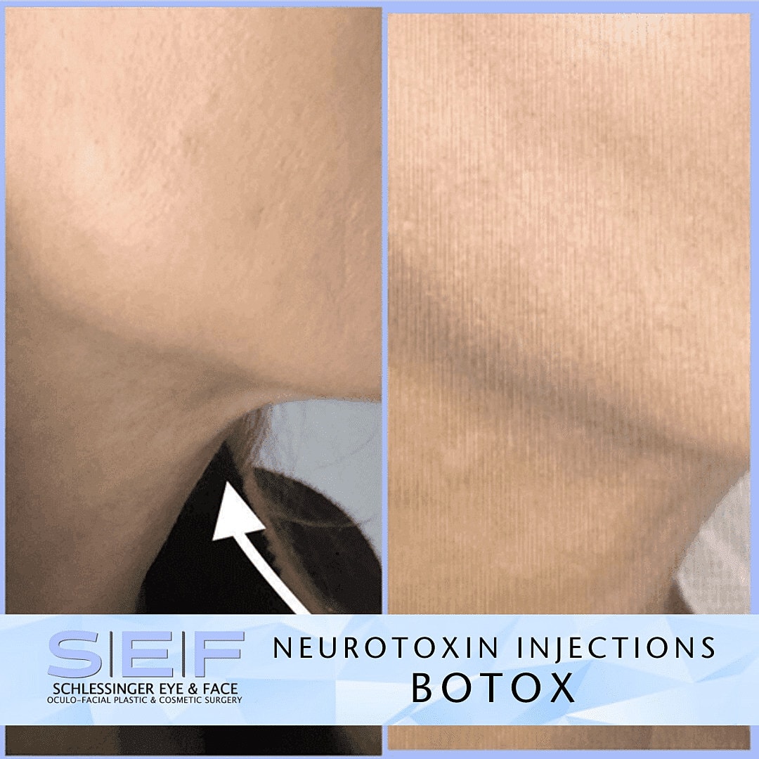 Botox Before & After