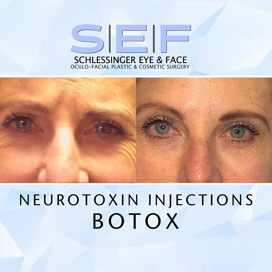 Botox Before & After