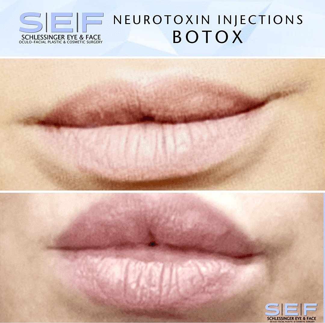 Botox Before & After
