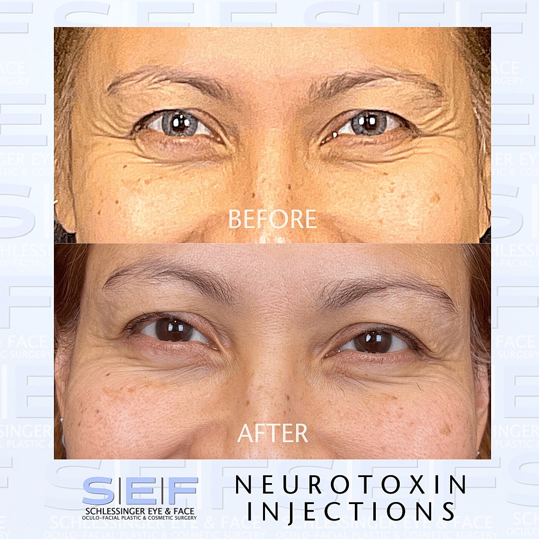 Botox Before & After