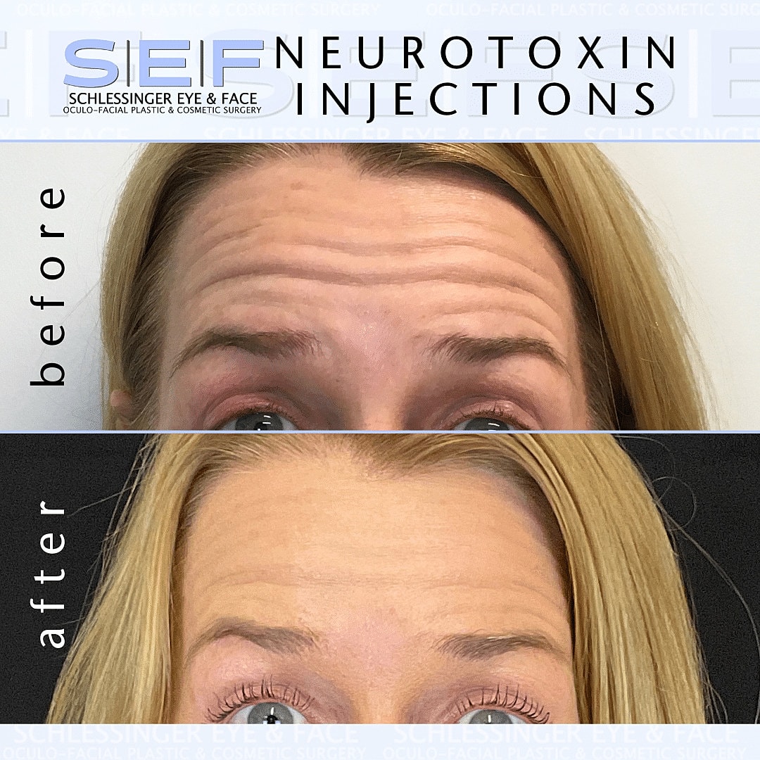 Botox Before & After