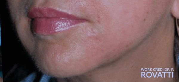 Morpheous and Facetite before and after