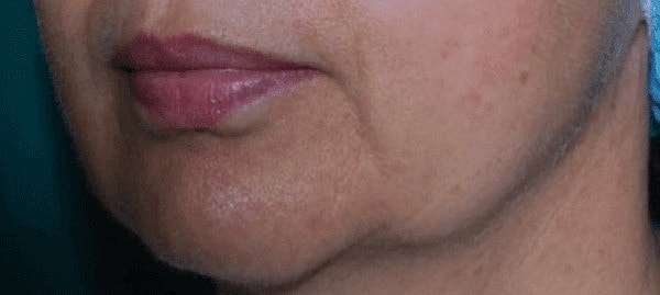 Morpheous and Facetite before and after