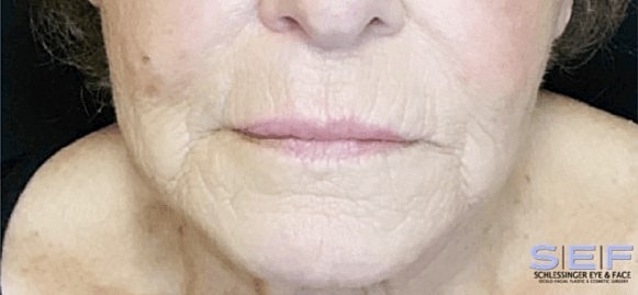 Morpheous 8 before and after 2 treatments