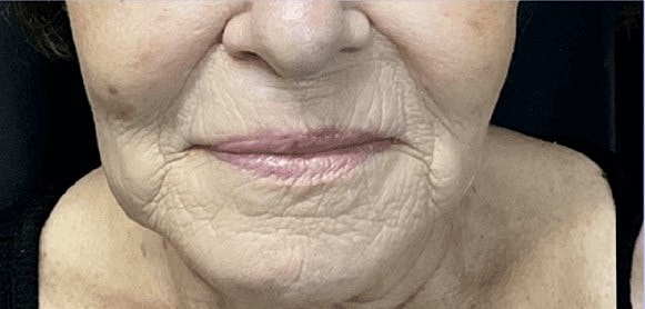 Morpheous 8 before and after 2 treatments