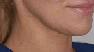 morpheous 8 before and after
