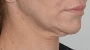 morpheous 8 before and after