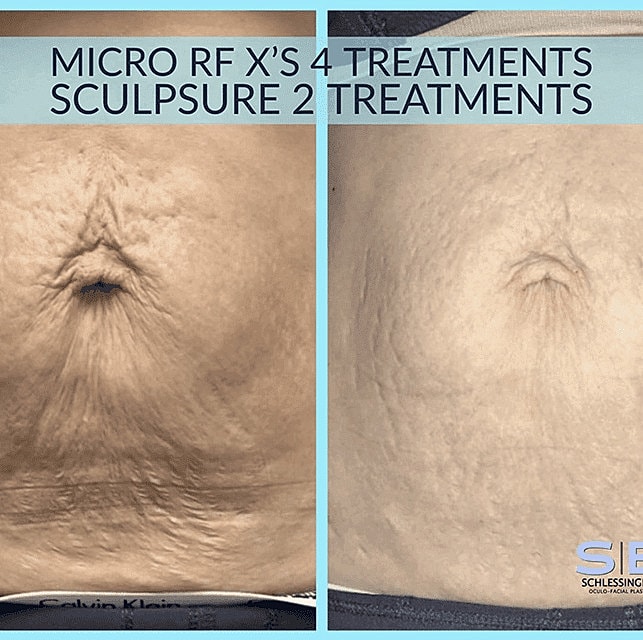 Rf Microneedling Before & After