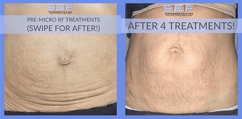 Rf Microneedling Before & After