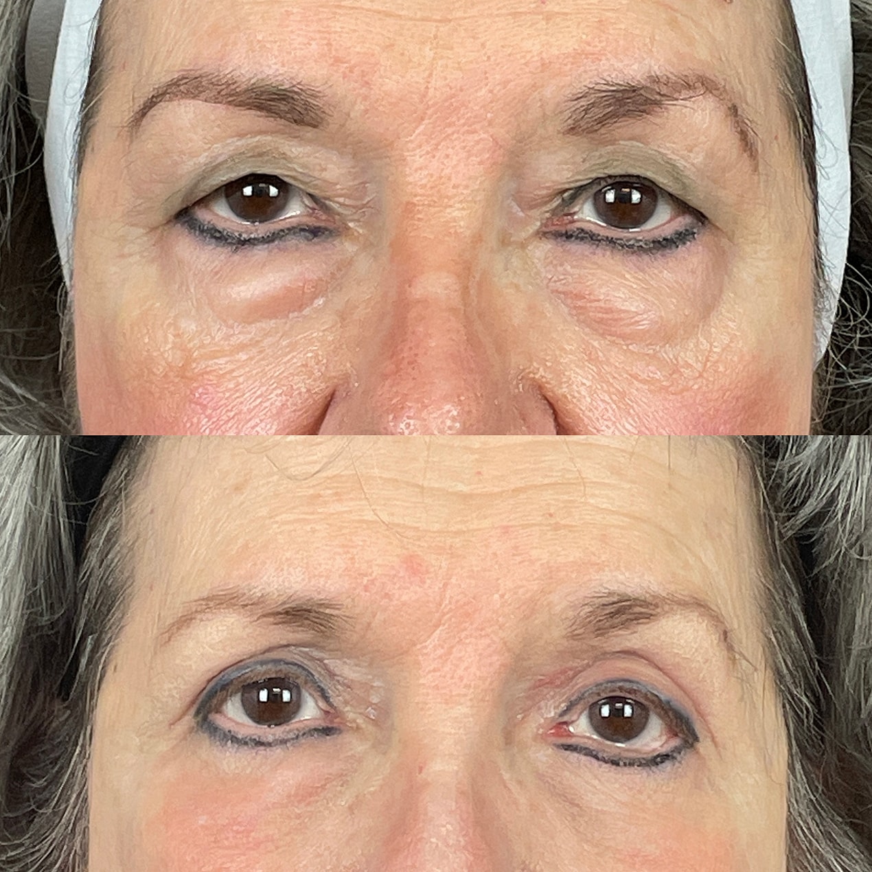 4 Lid Blepharoplasty Before & After