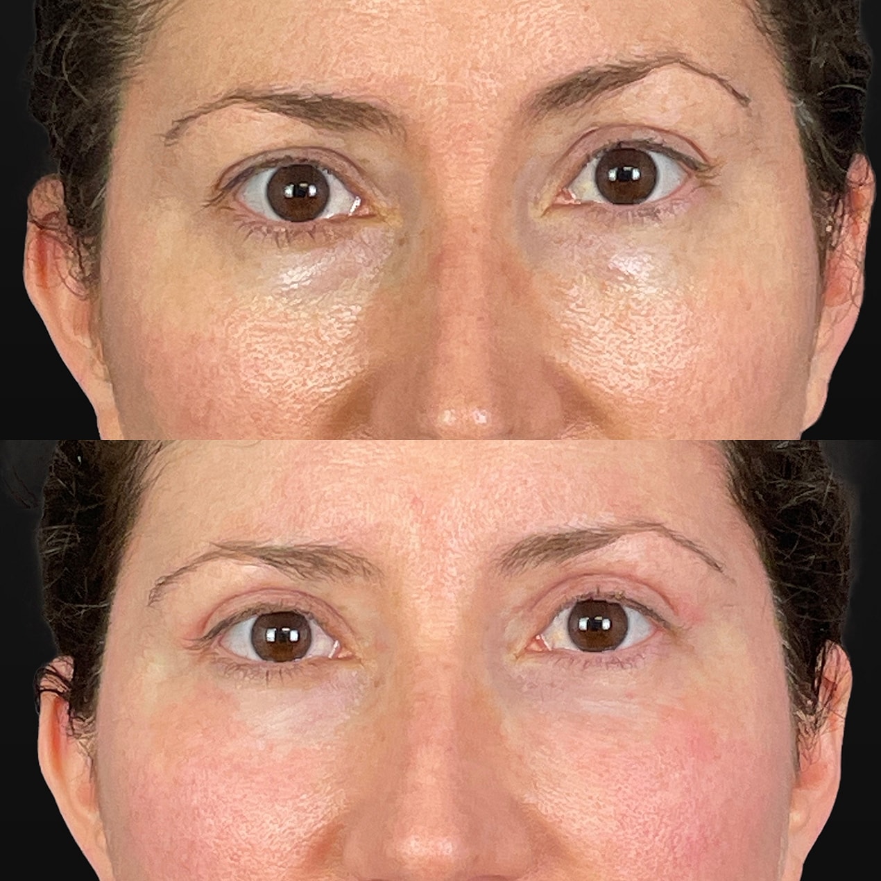 4 Lid Blepharoplasty Before & After