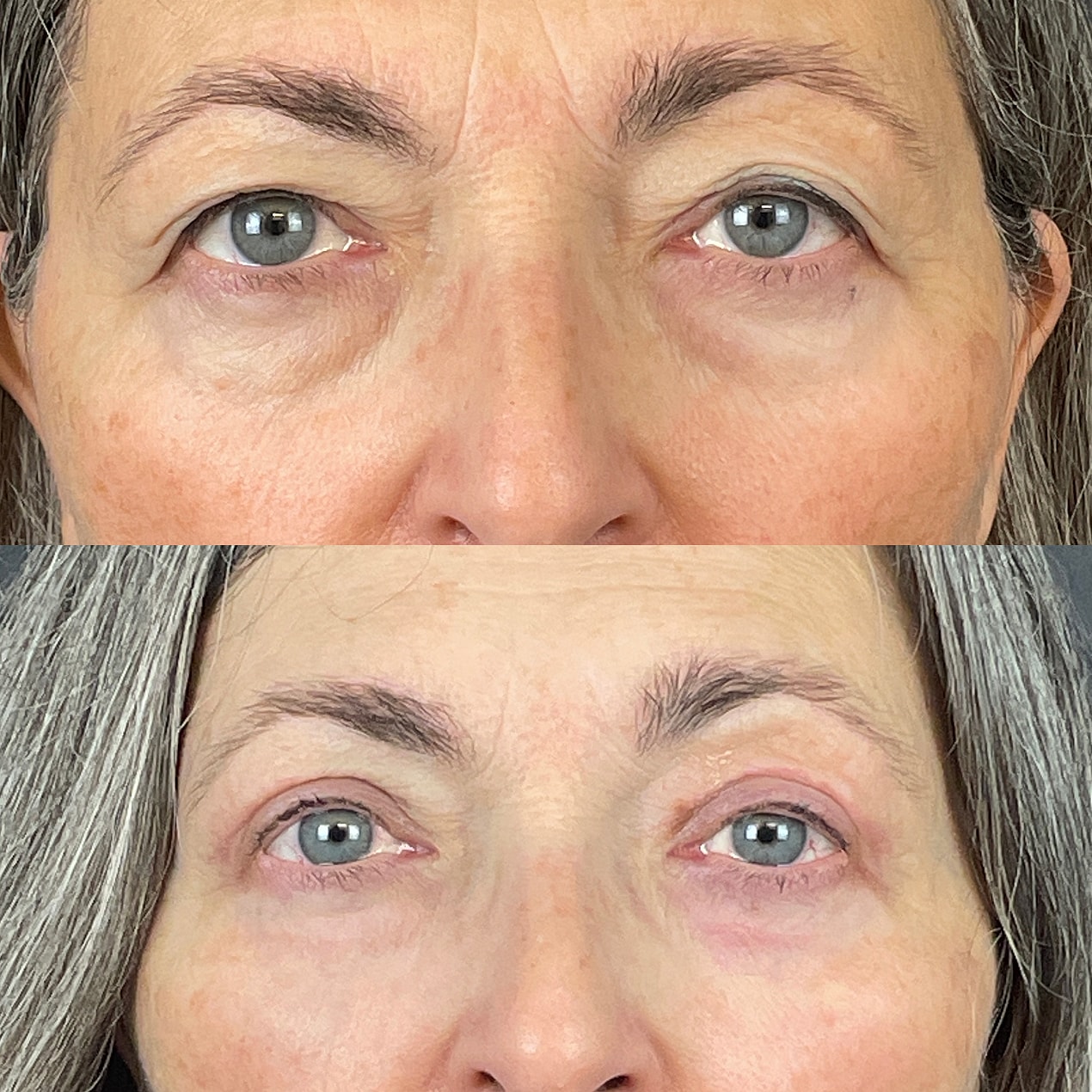 4 Lid Blepharoplasty Before & After