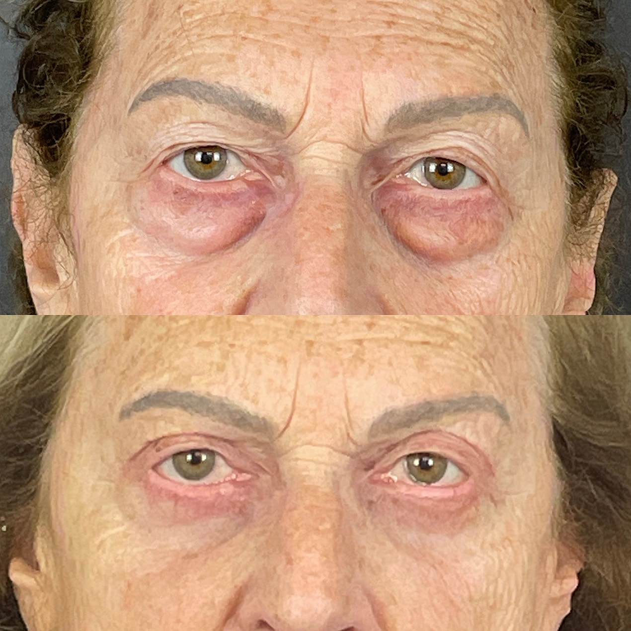 4 Lid Blepharoplasty Before & After