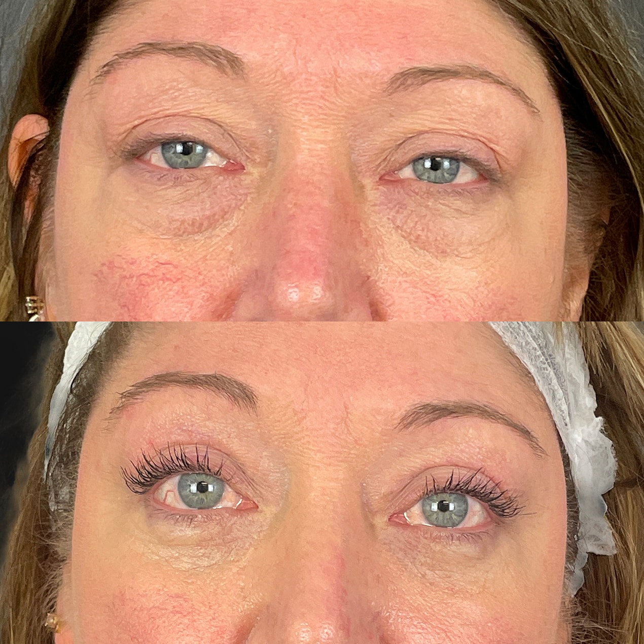 4 Lid Blepharoplasty Before & After
