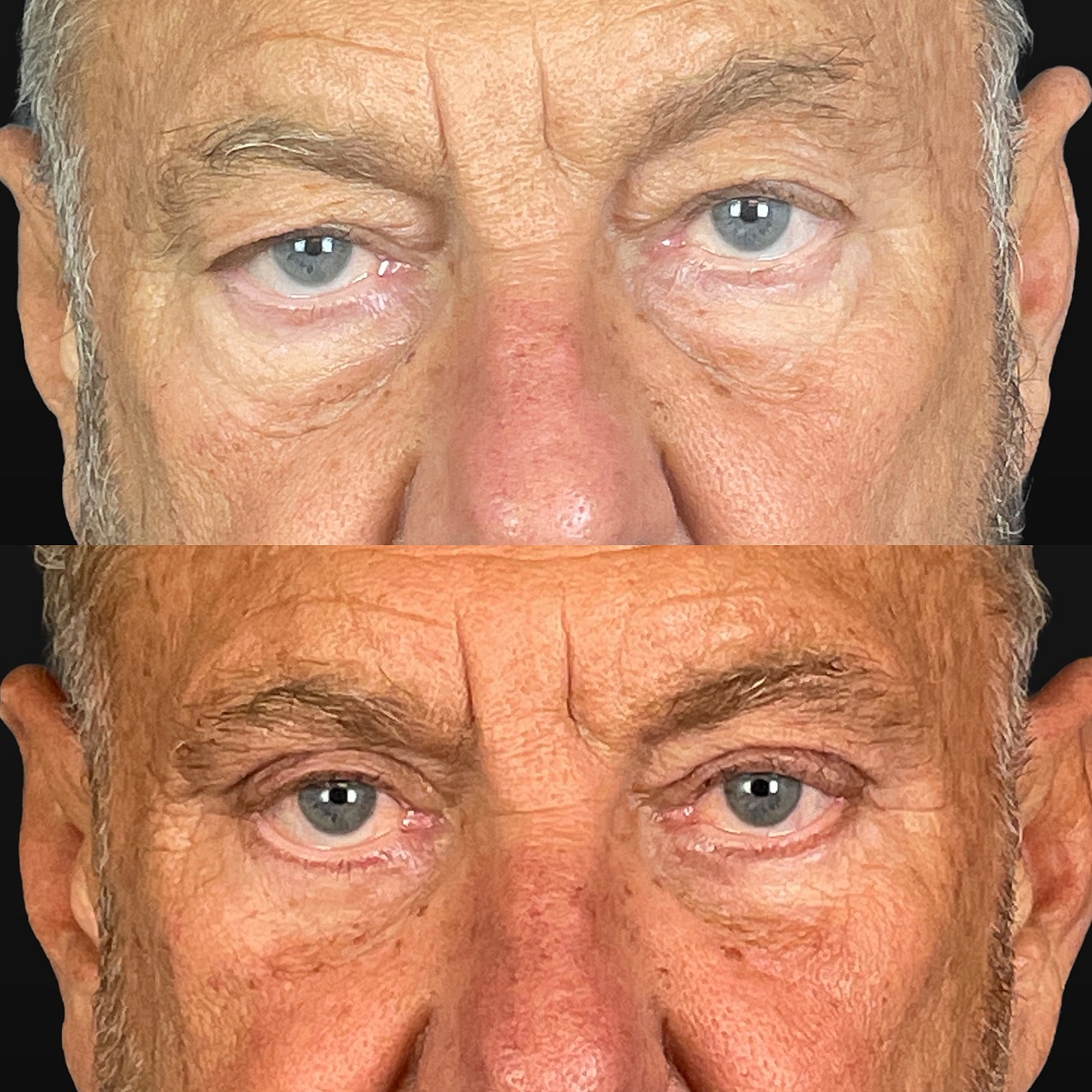 4 Lid Blepharoplasty Before & After