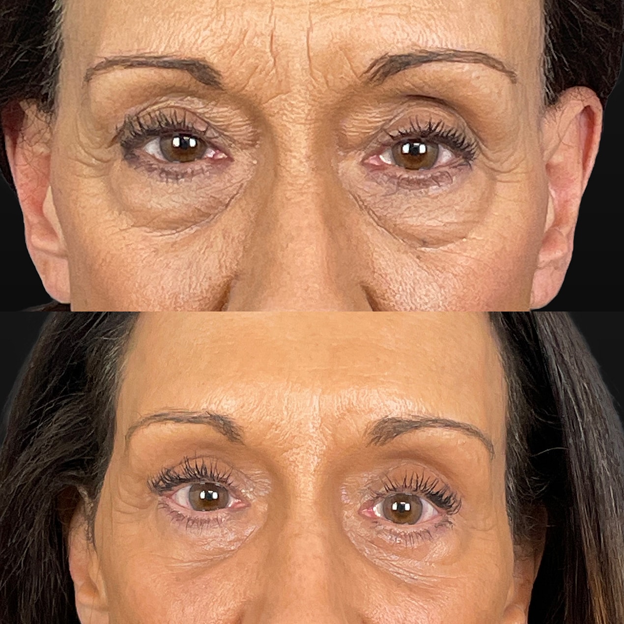 4 Lid Blepharoplasty Before & After