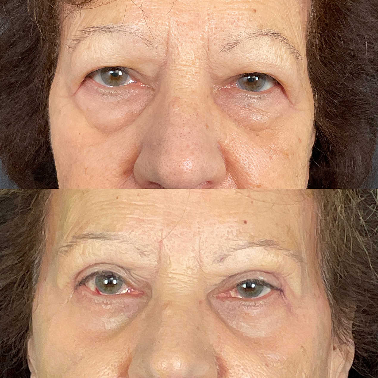 4 Lid Blepharoplasty Before & After