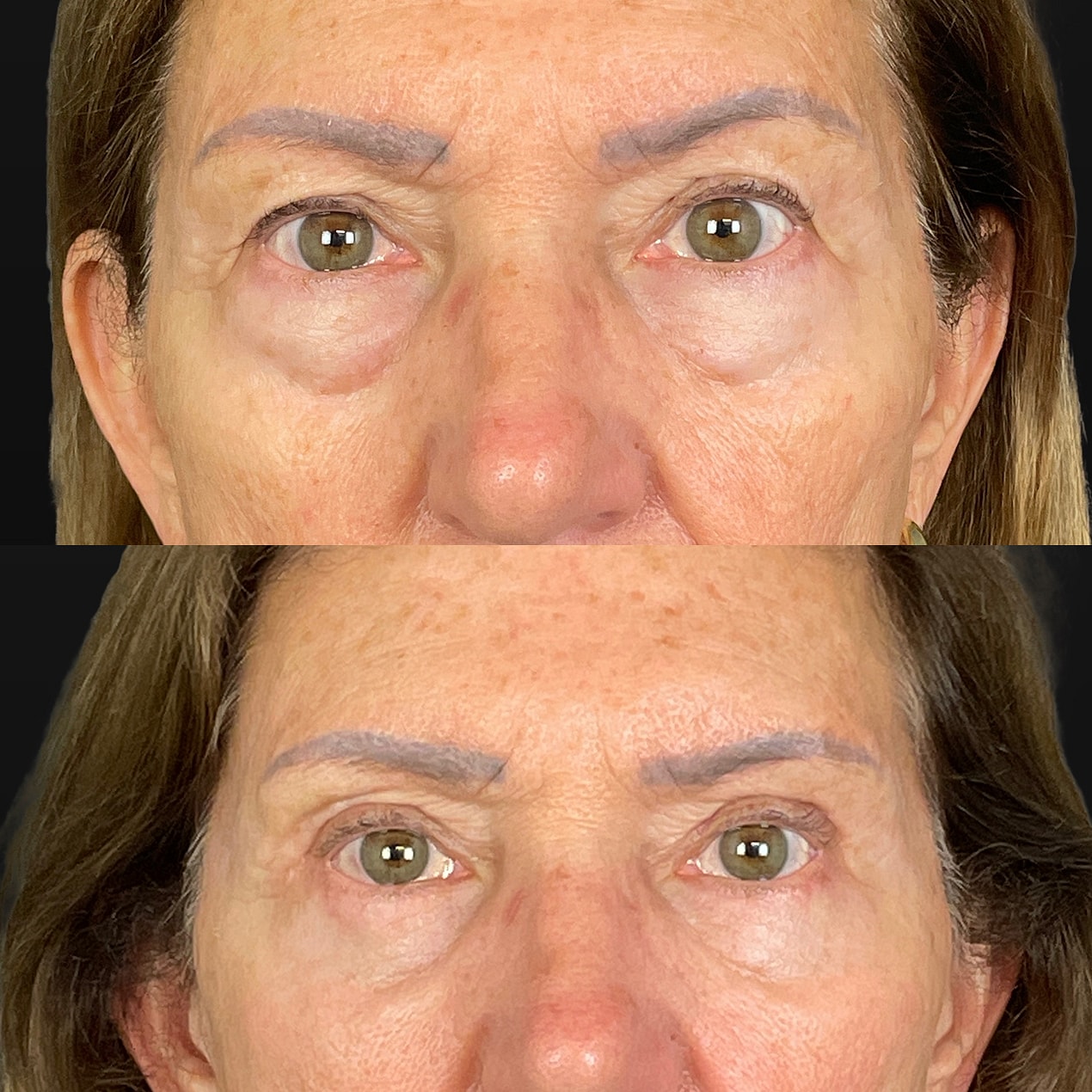 4 Lid Blepharoplasty Before & After