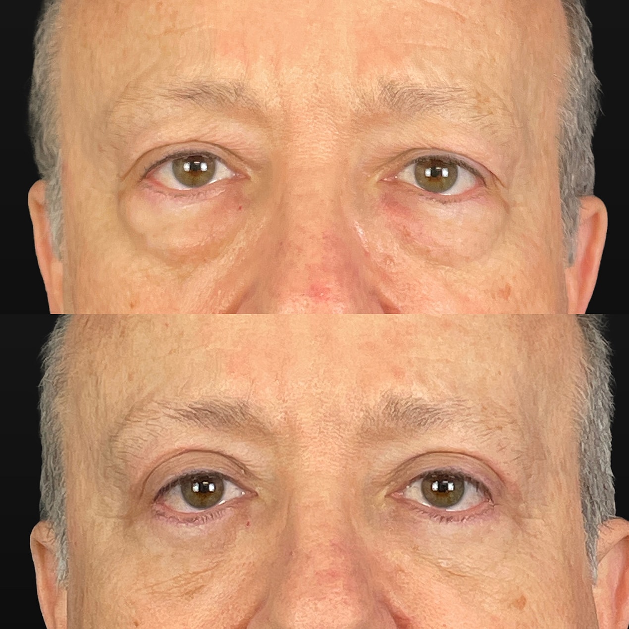 4 Lid Blepharoplasty Before & After