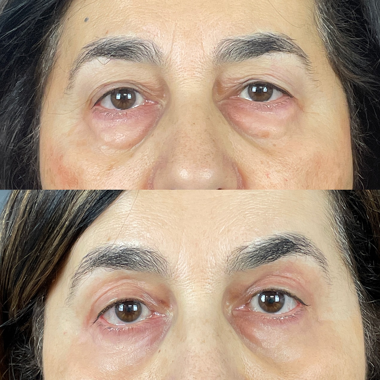 4 Lid Blepharoplasty Before & After