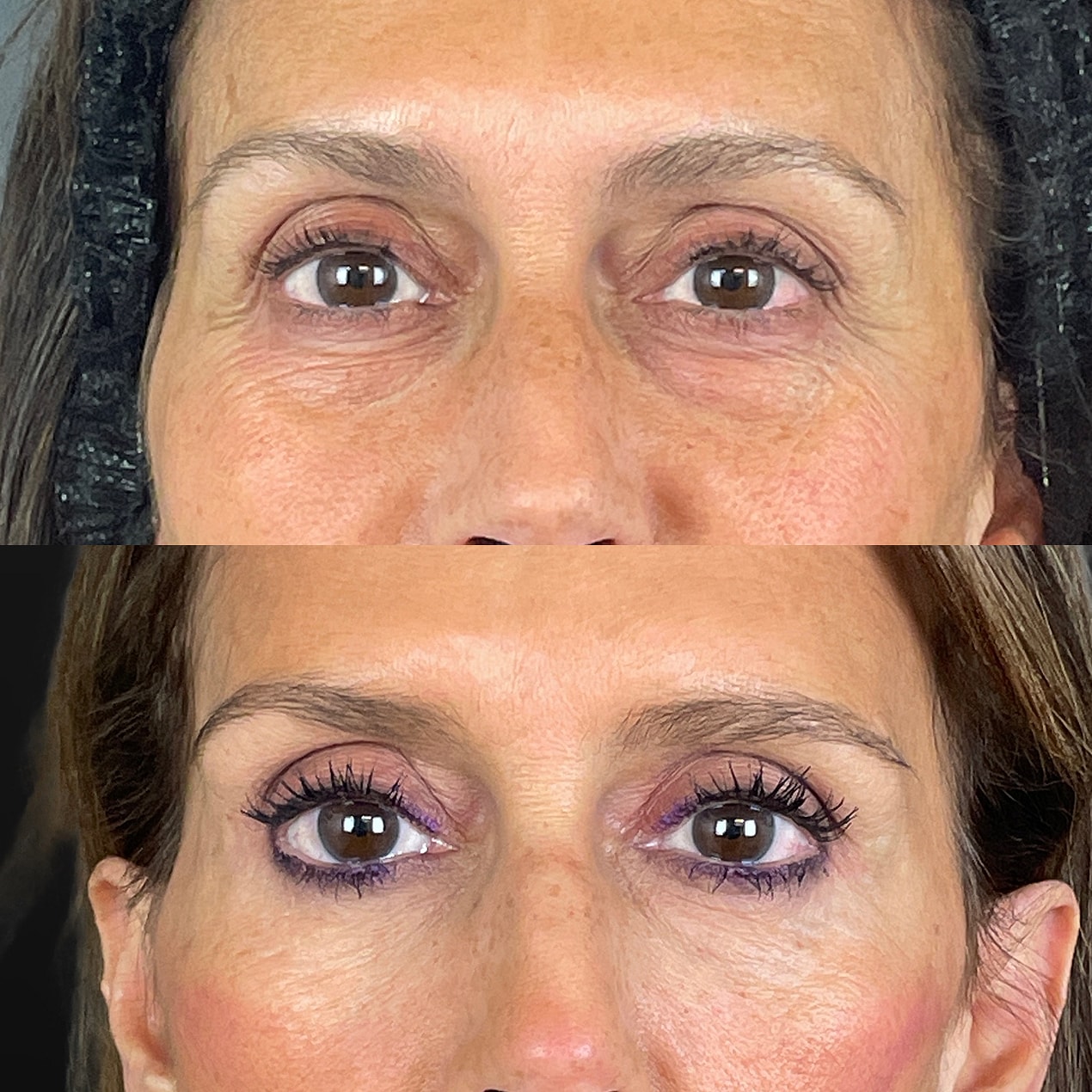 4 Lid Blepharoplasty Before & After