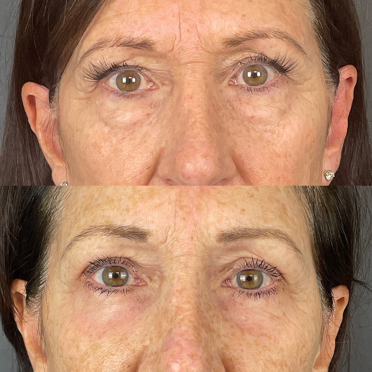 4 Lid Blepharoplasty Before & After