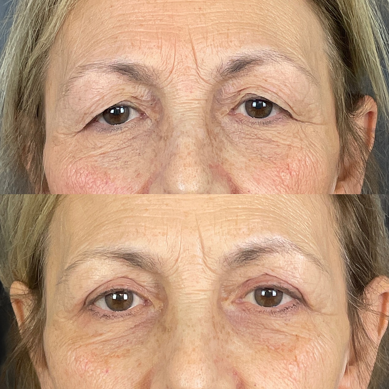 Upper  Blepharoplasty Before & After