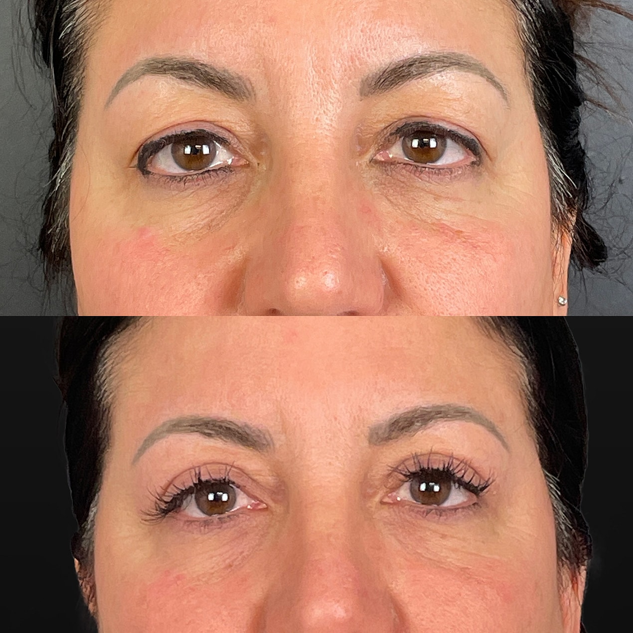 Upper  Blepharoplasty Before & After