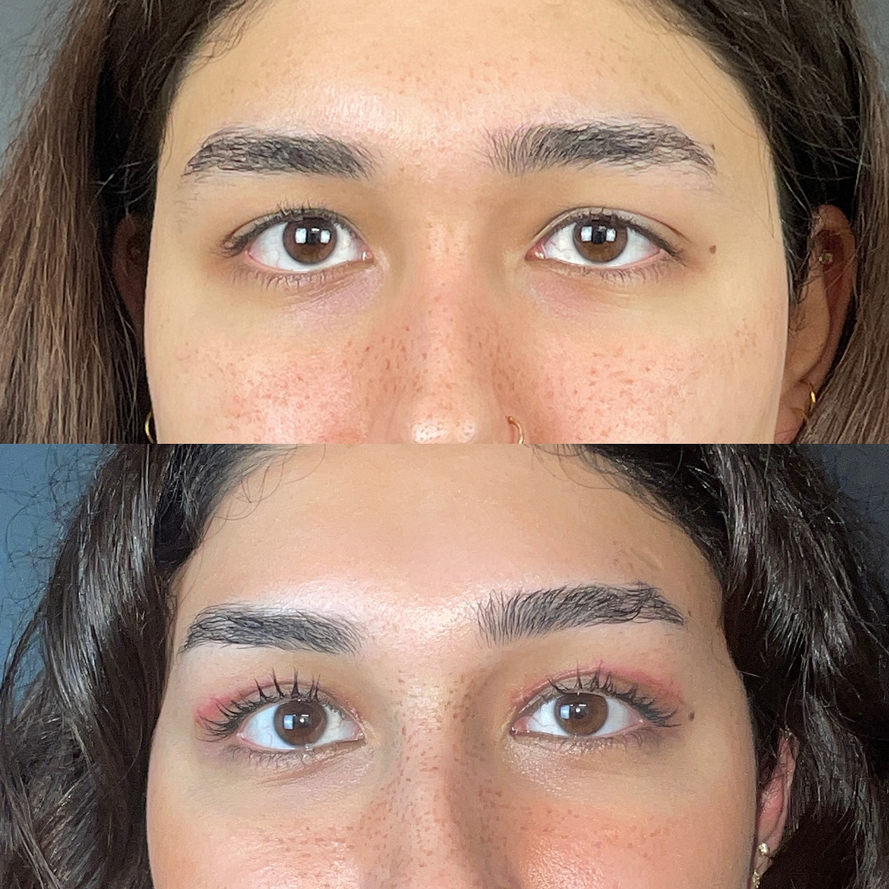 Upper  Blepharoplasty Before & After