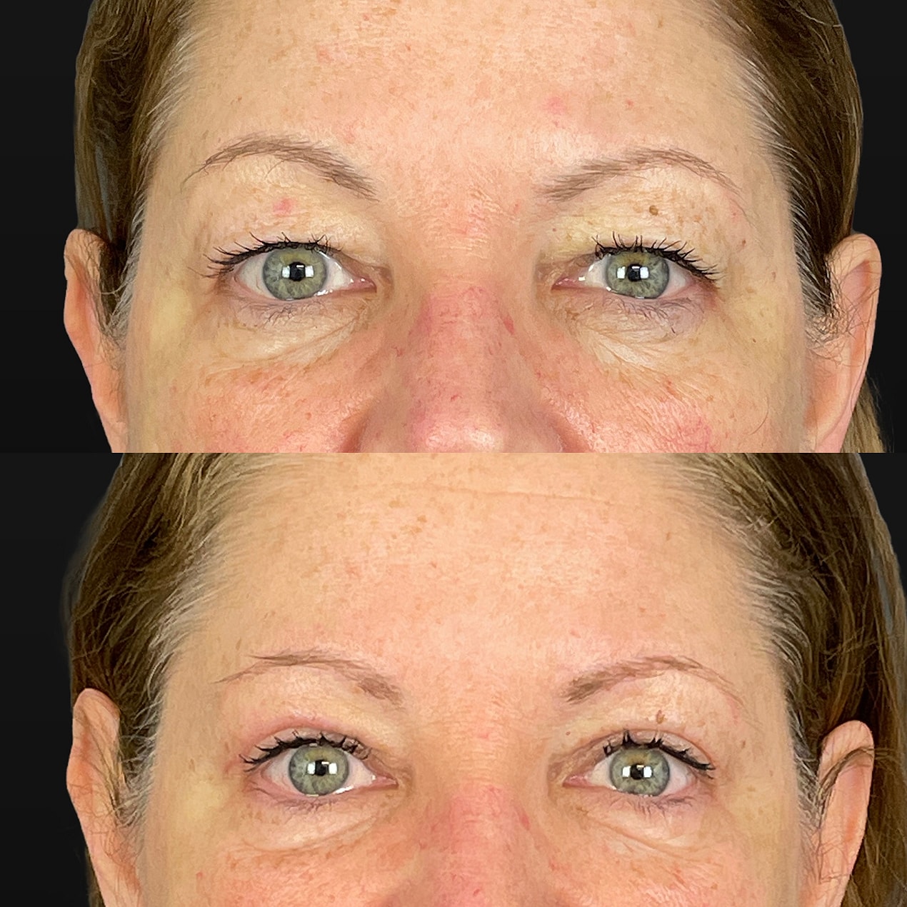 Upper  Blepharoplasty Before & After
