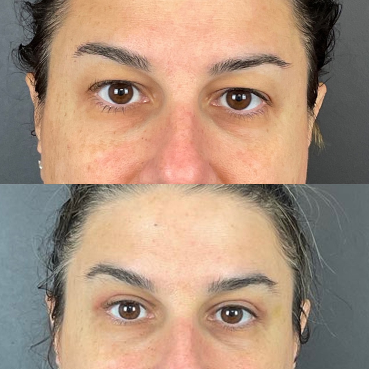Upper  Blepharoplasty Before & After